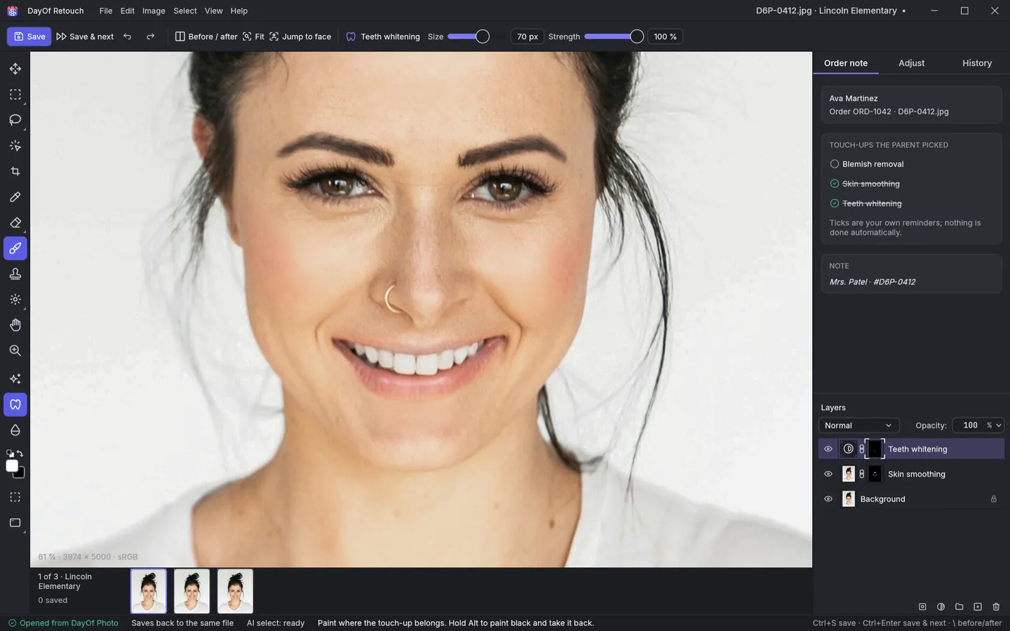 Teeth whitening zoomed in on the smile